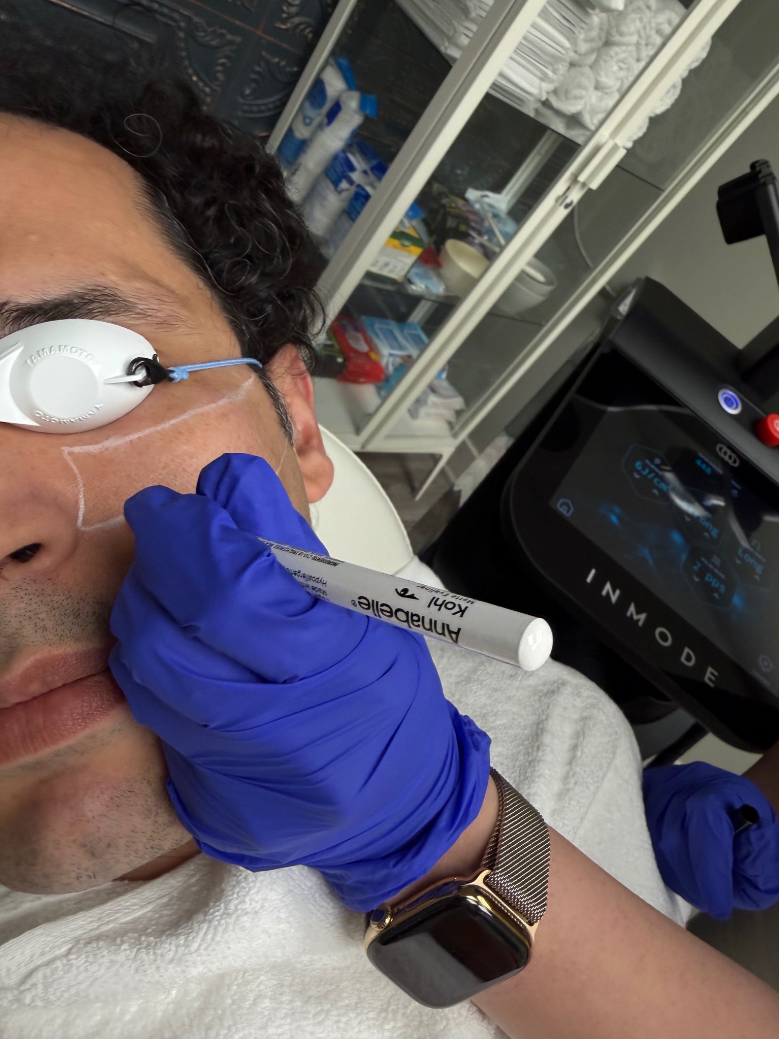 Men facial laser hair removal treatment at Luminova