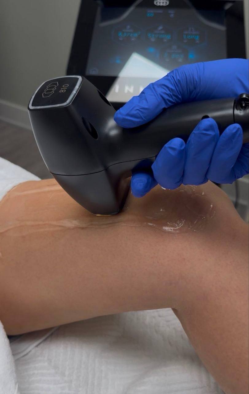 Laser hair removal applicator during treatment
